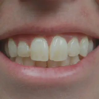 /img/30068-teeth-whitening-erie-pa-image7.webp