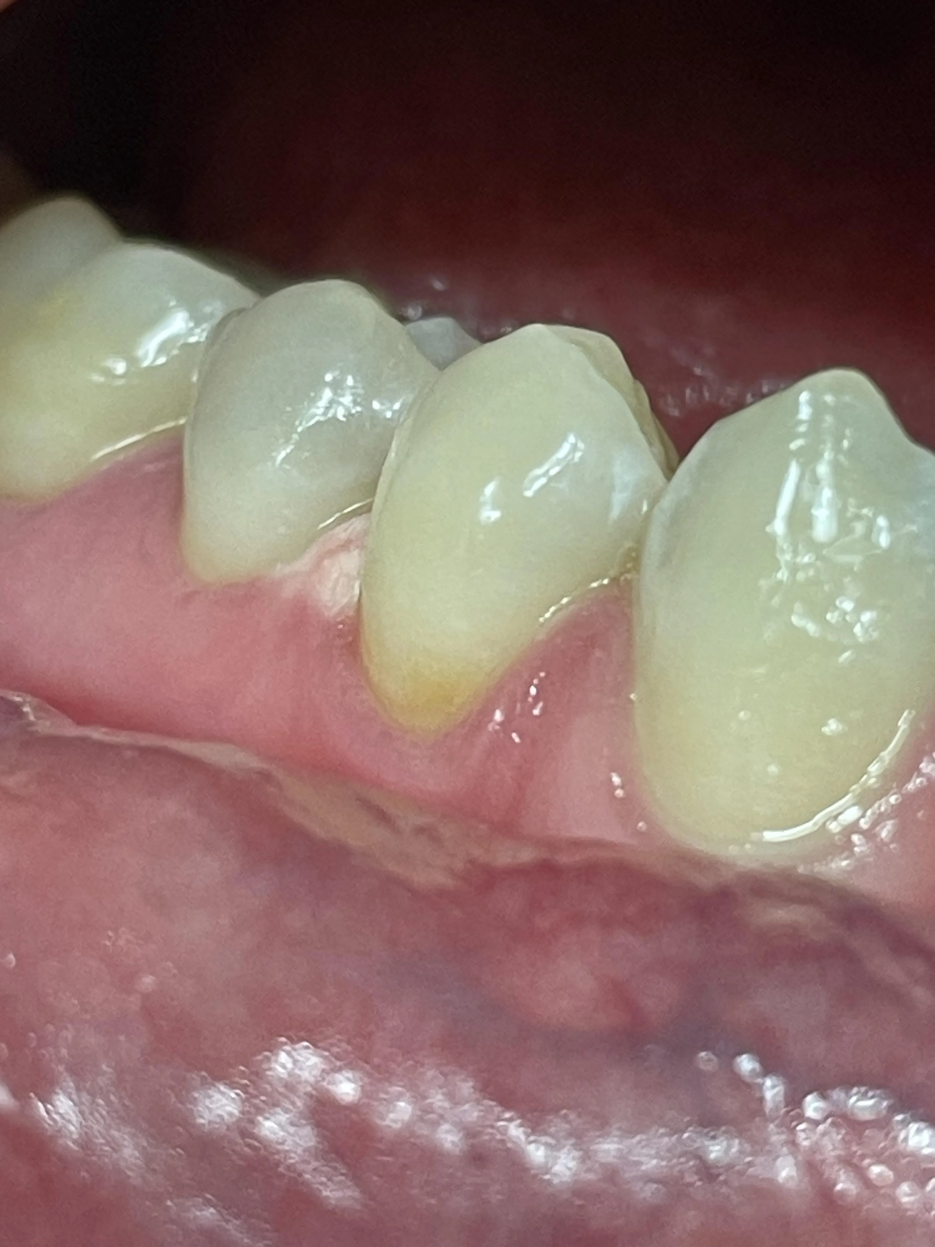 30080 professional teeth whitening