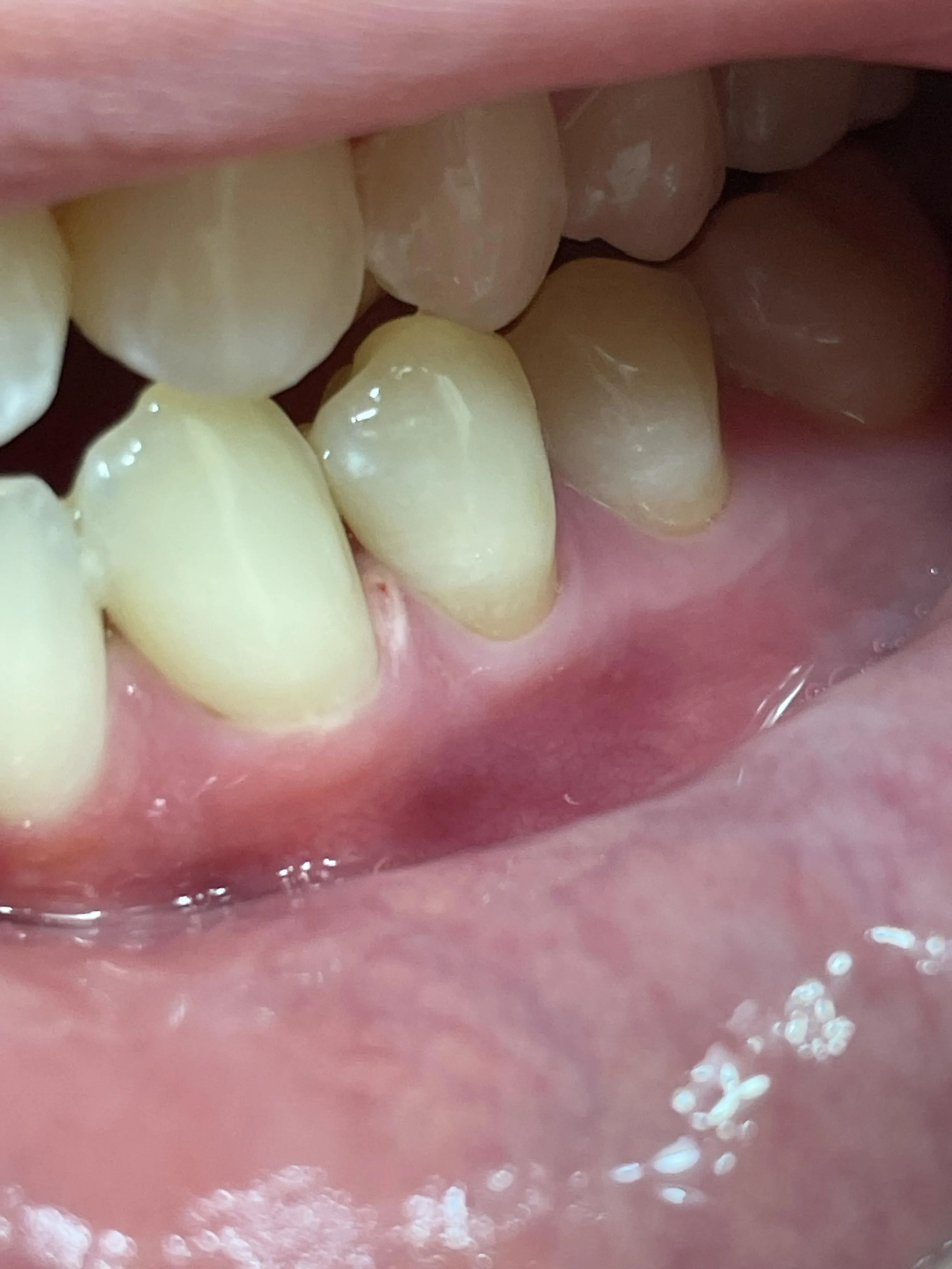 30080 whitening strips application