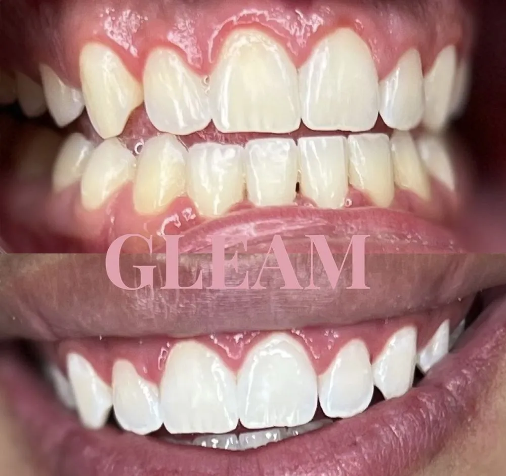 30085 at home teeth whitening