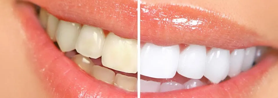 30085 professional whitening trays