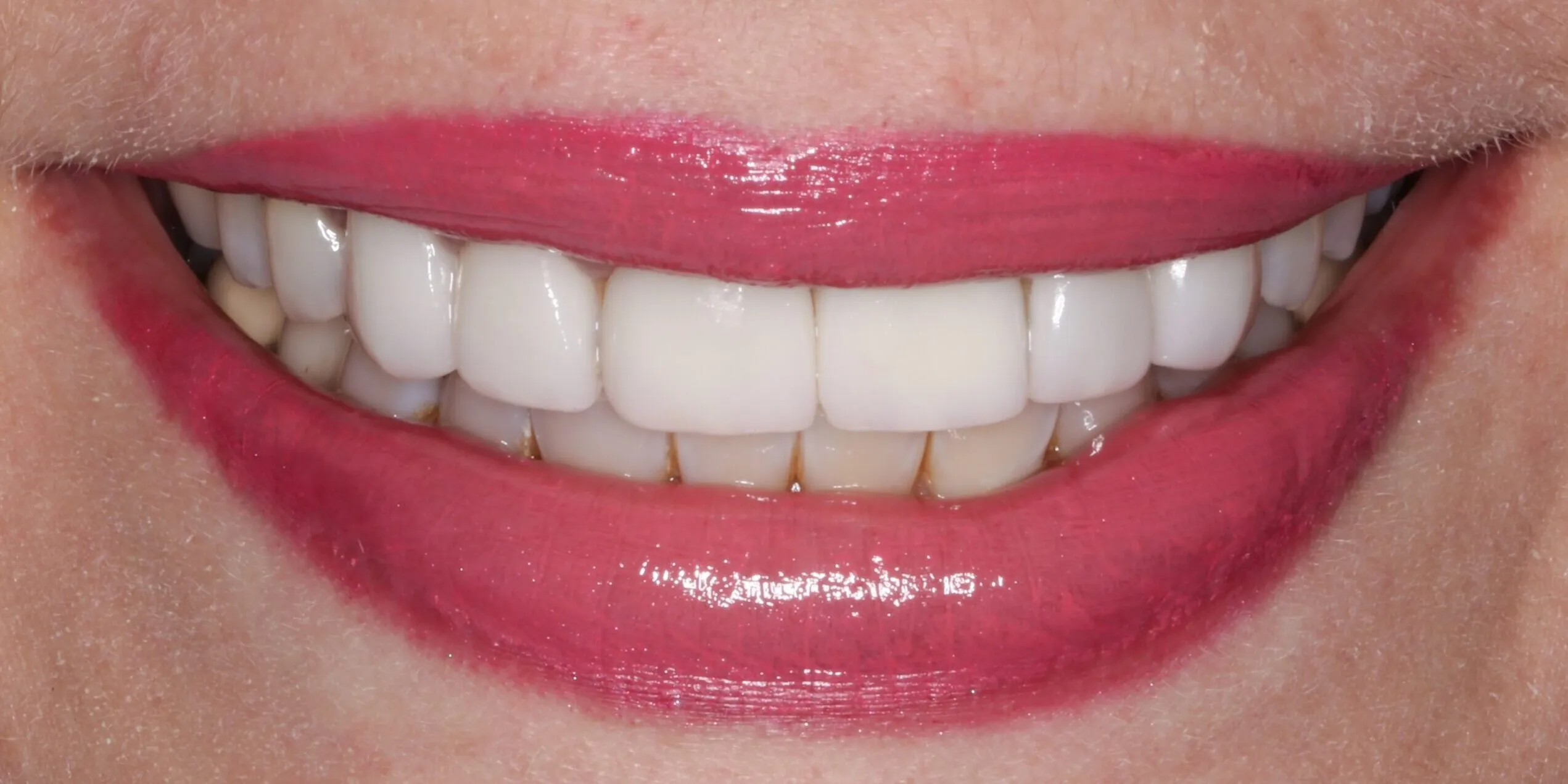 /img/30085-teeth-whitening-results.webp