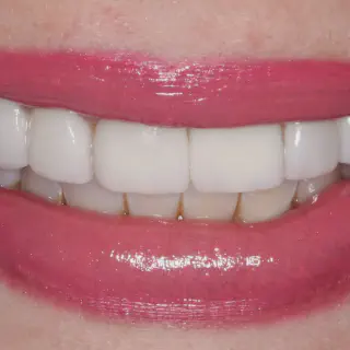 /img/30085-teeth-whitening-results.webp