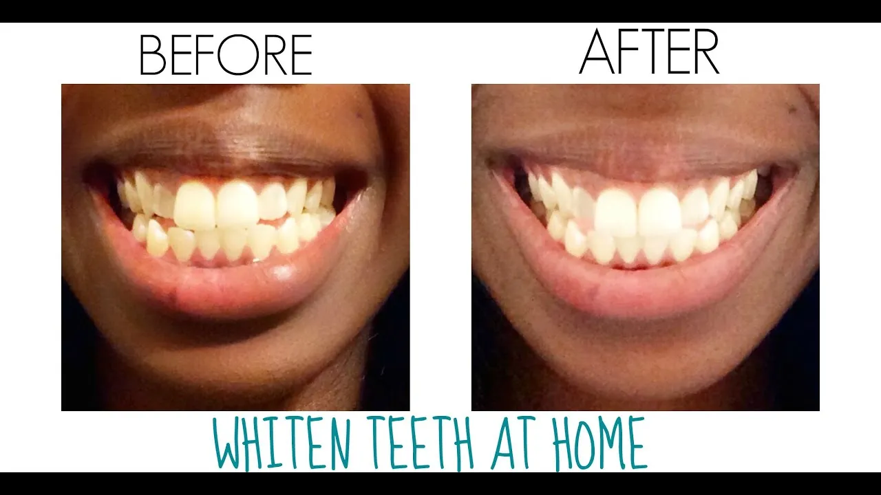 30087 in office whitening