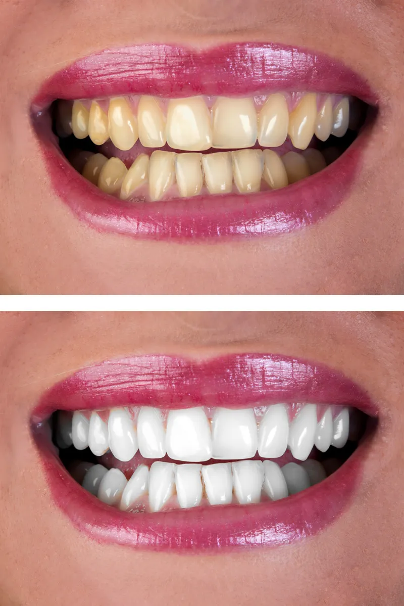 30088 at home whitening kits