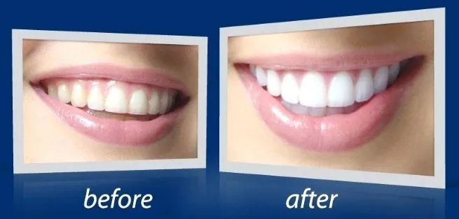 30094 rembrandt teeth whitening user reviews