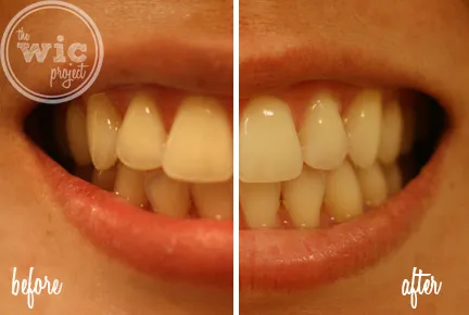 30094 teeth whitening before after