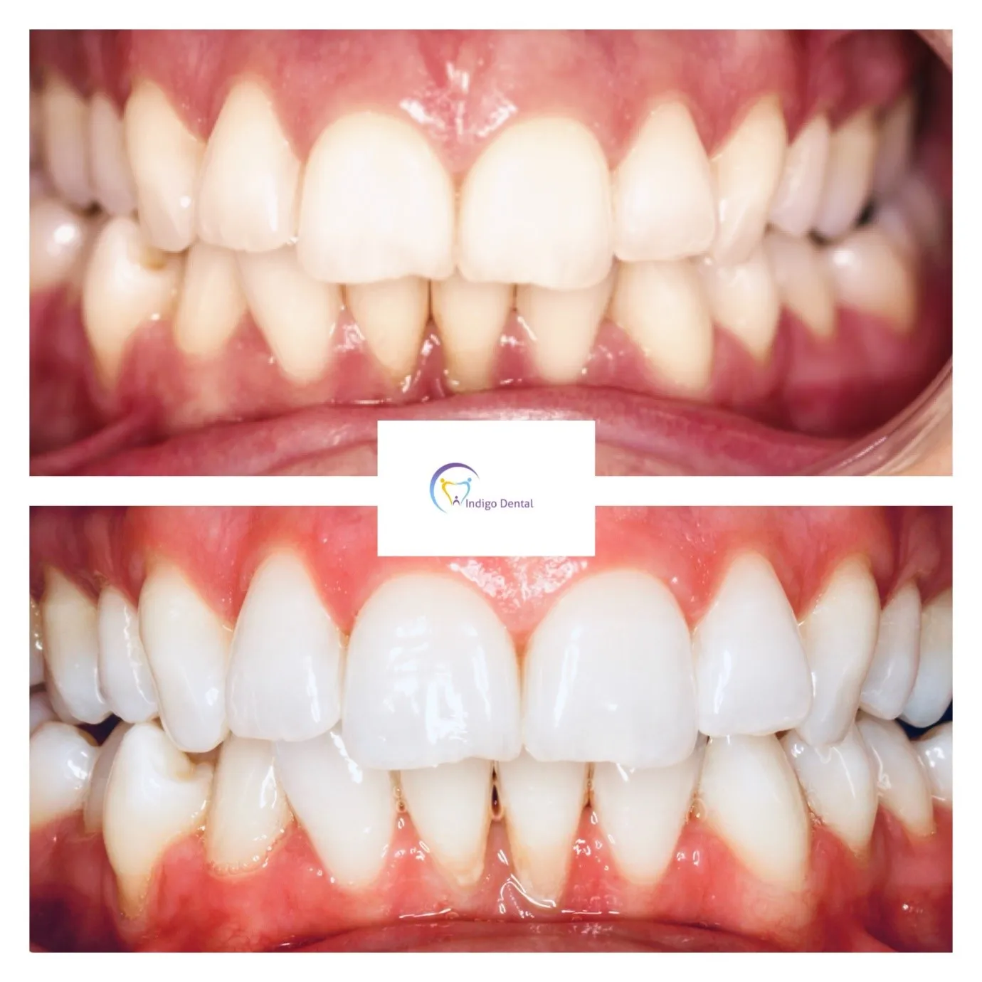 30096 in office teeth whitening