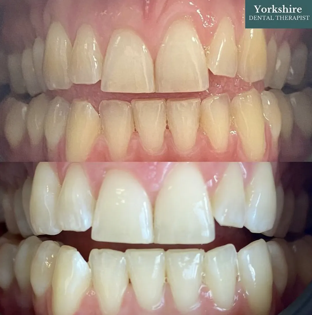 30096 teeth whitening aftercare