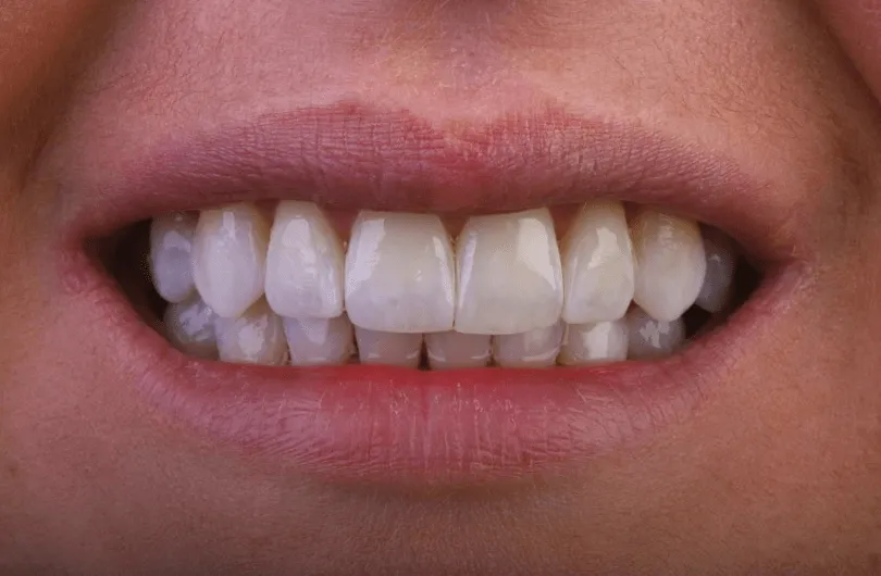30096 teeth whitening options