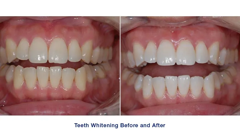 30098 in office teeth whitening
