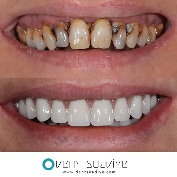 30101 cavity prevention