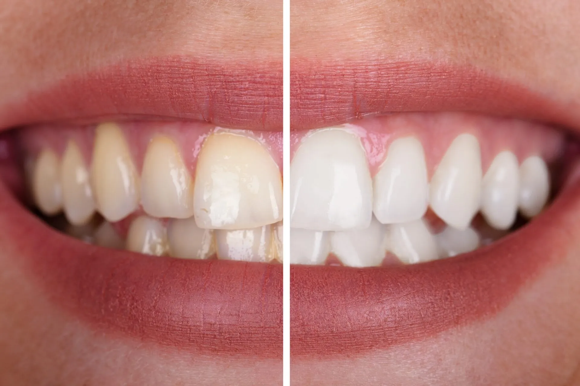 30103 dental veneers