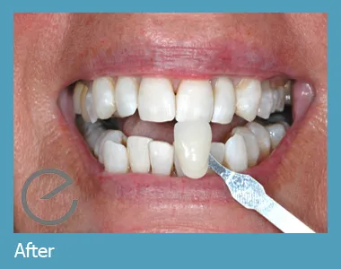 30107 at home teeth whitening kits