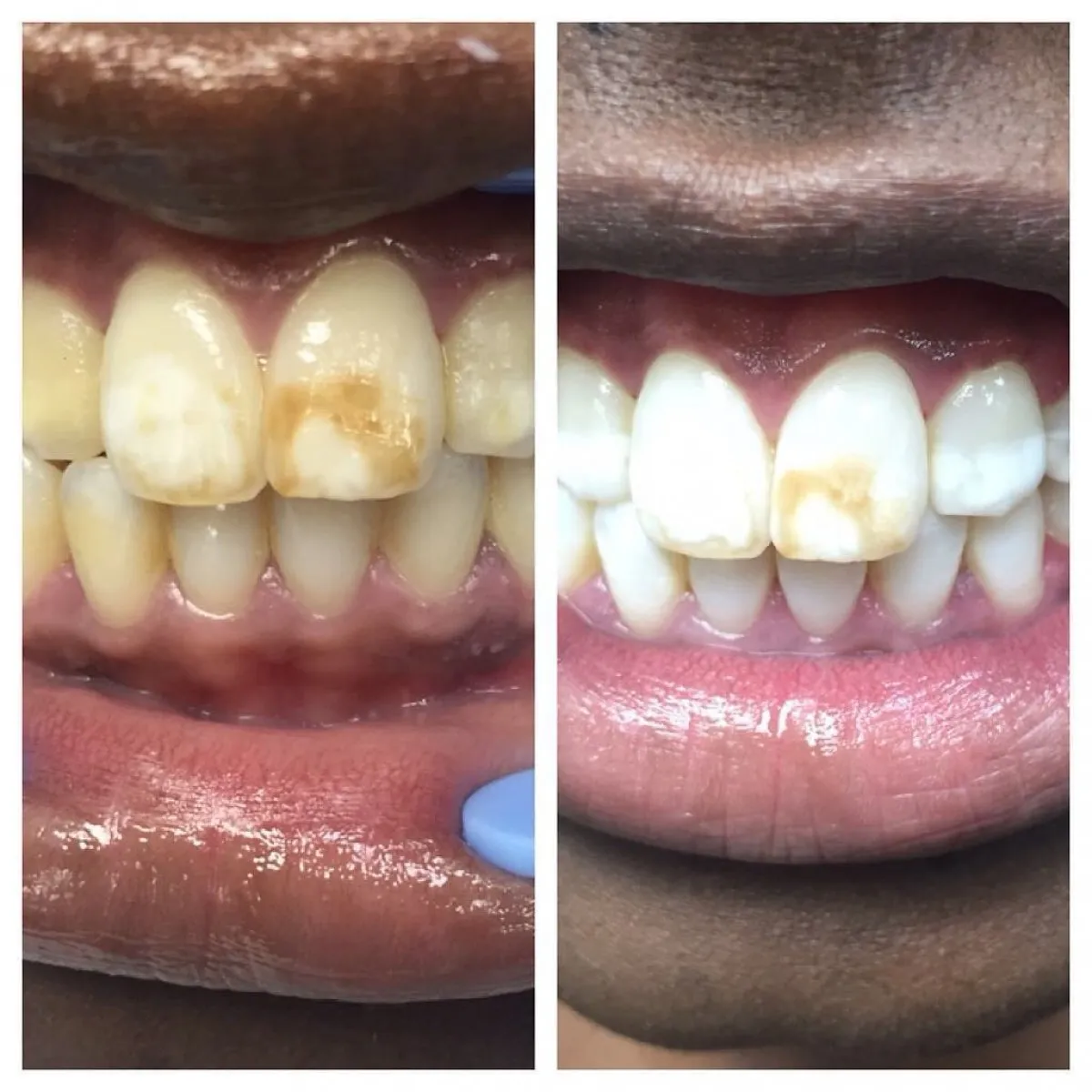 30107 teeth whitening kingston dentist recommendations