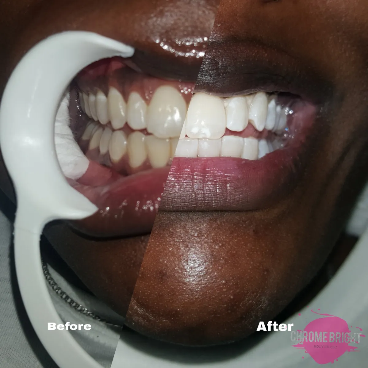 30107 teeth whitening kingston maintenance