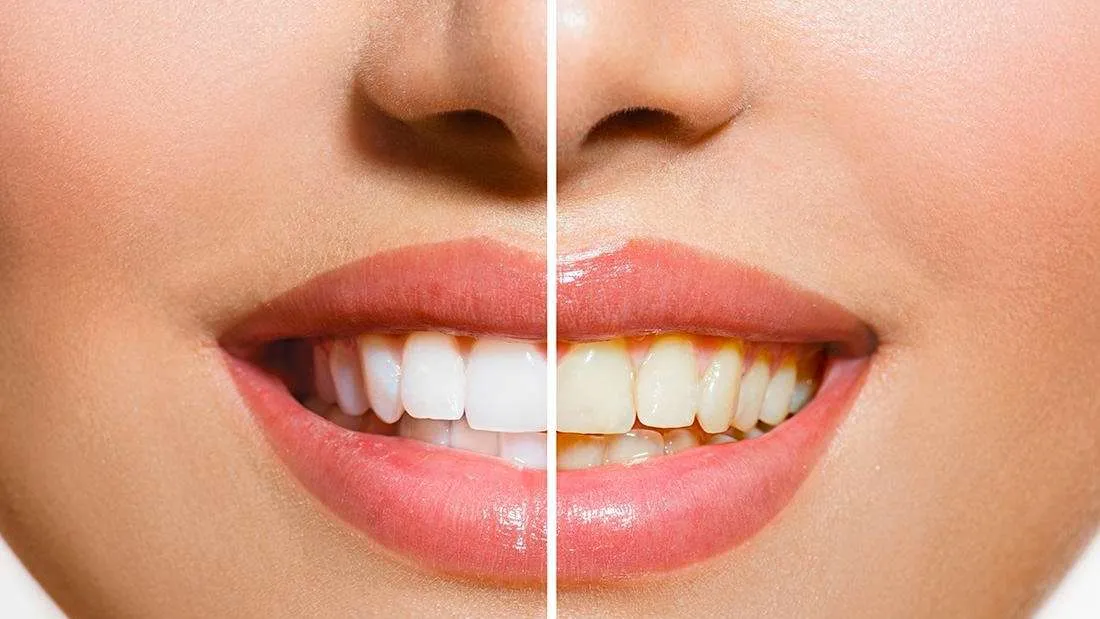 30108 whitening pens