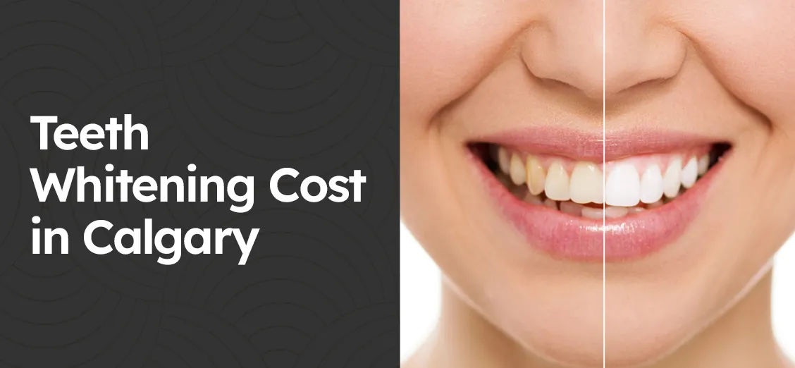 30109 laser teeth whitening calgary