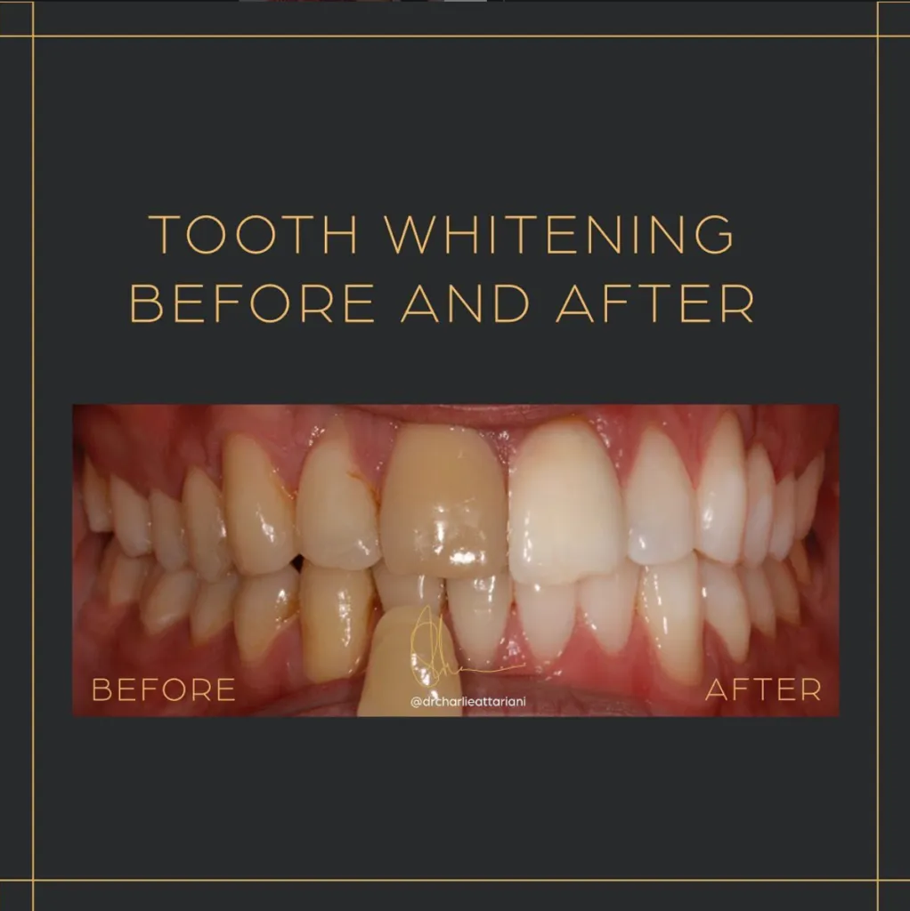 30109 laser teeth whitening results