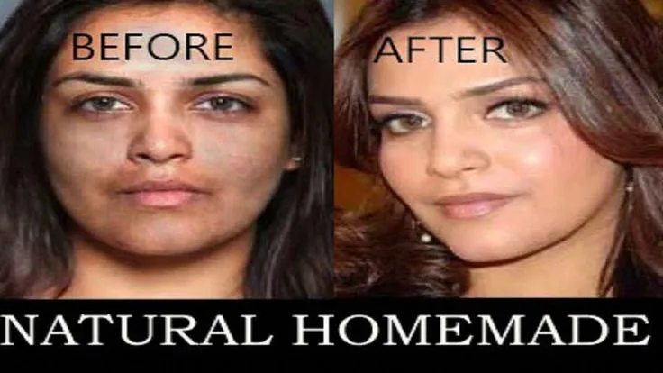 30110 skin whitening before after