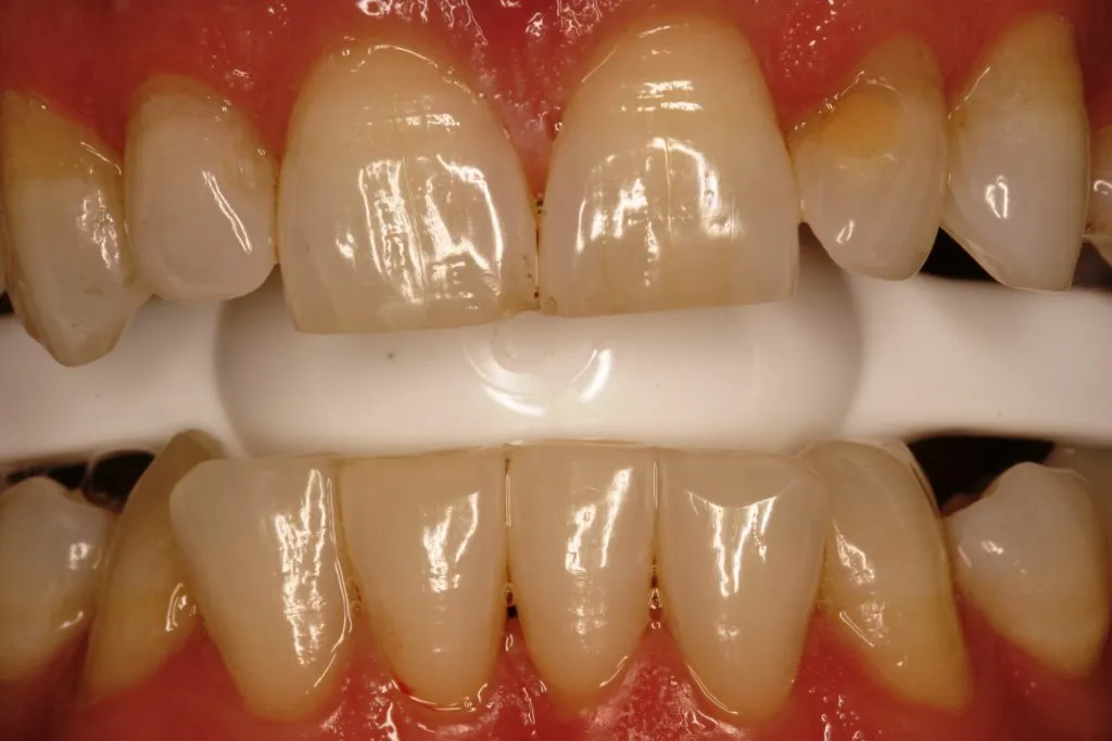 30113 zoom teeth whitening memphis tn before after