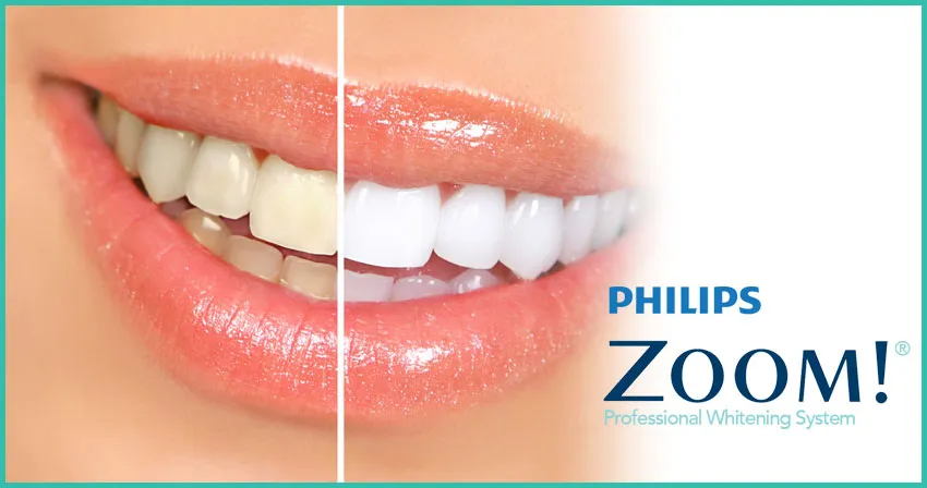 /img/30113-zoom-teeth-whitening-memphis-tn-comparison.webp