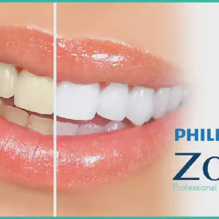 /img/30113-zoom-teeth-whitening-memphis-tn-comparison.webp