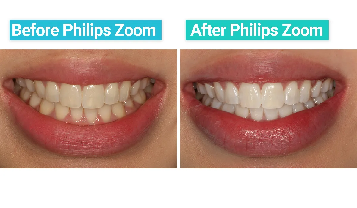 30113 zoom teeth whitening memphis tn dentist