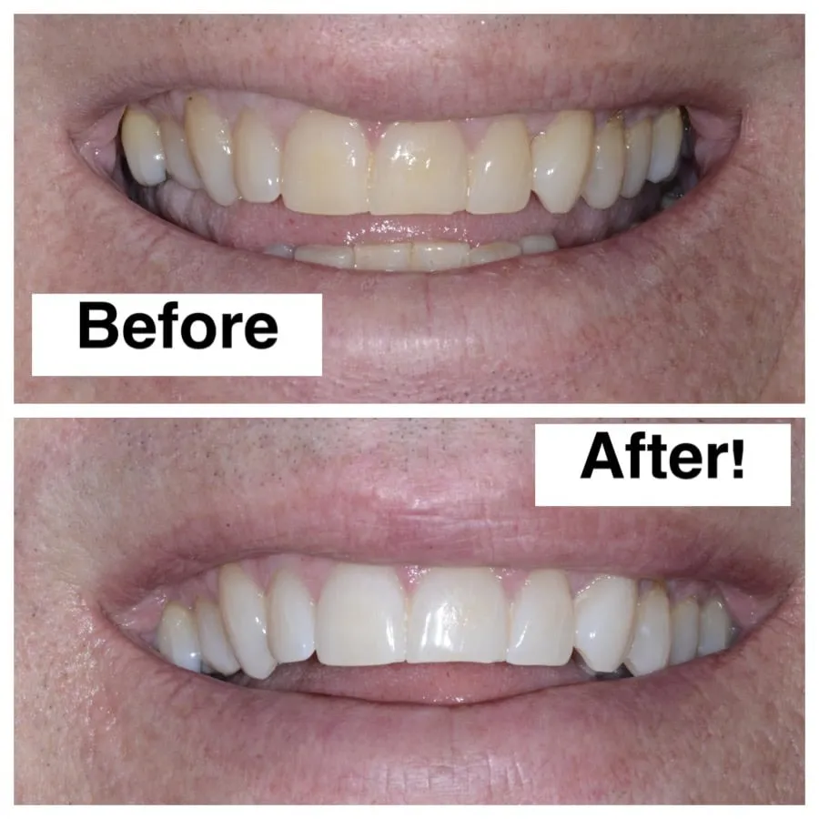 30113 zoom teeth whitening memphis tn oral hygiene