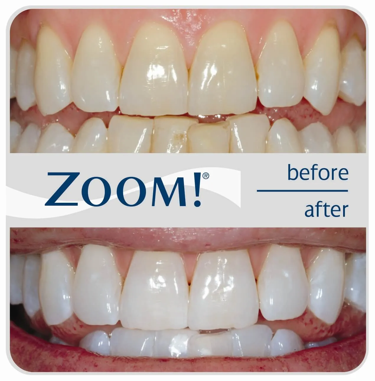 30113 zoom teeth whitening memphis tn process