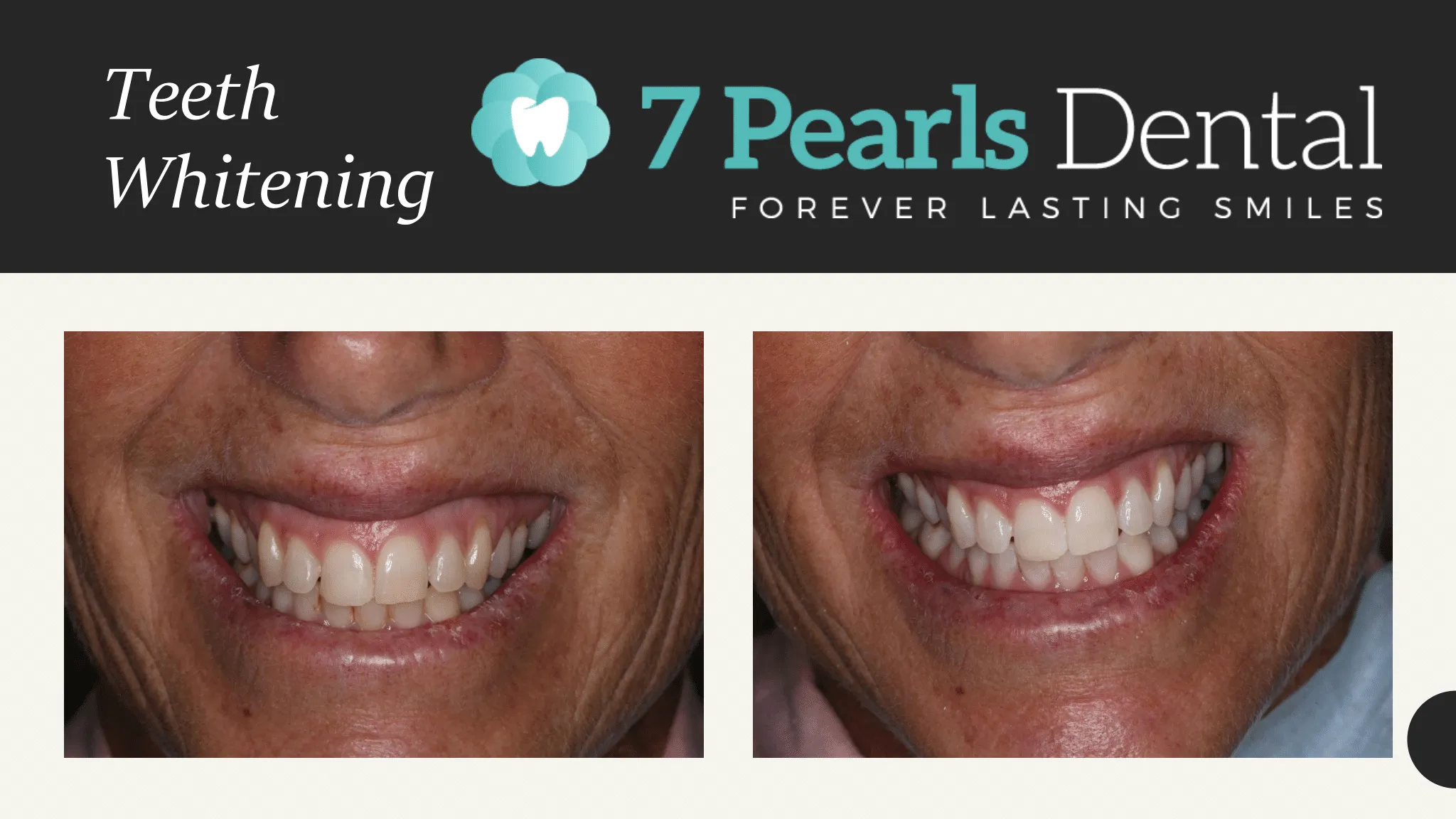 30115 teeth whitening Newcastle 2