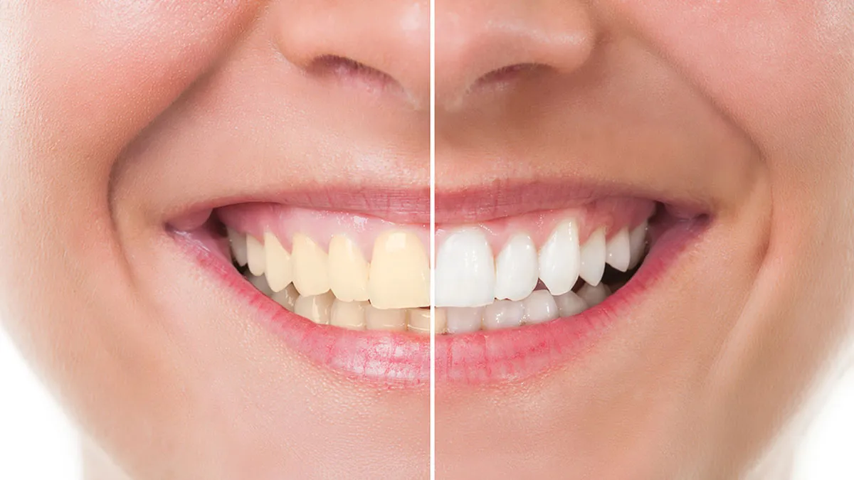 30115 teeth whitening Newcastle 3