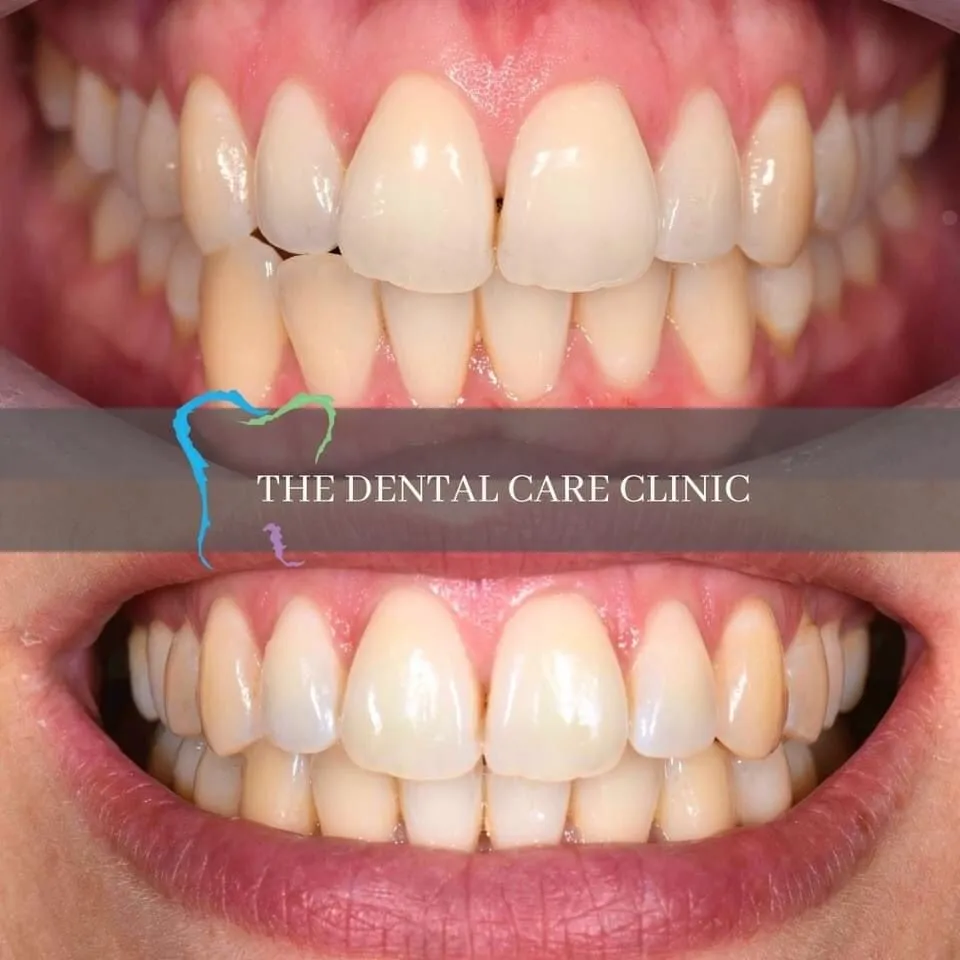 30115 teeth whitening Newcastle 4