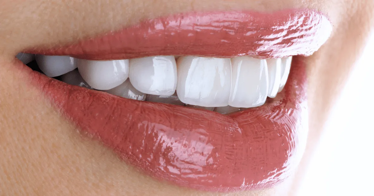 /img/30115-teeth-whitening-Newcastle-7.webp