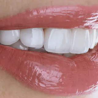 /img/30115-teeth-whitening-Newcastle-7.webp