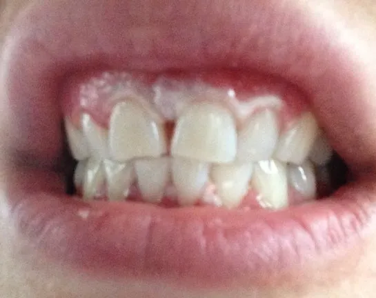 30116 gel concentration