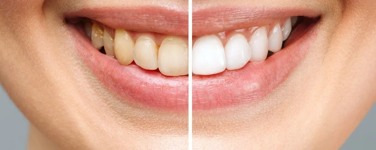 30116 teeth whitening gel