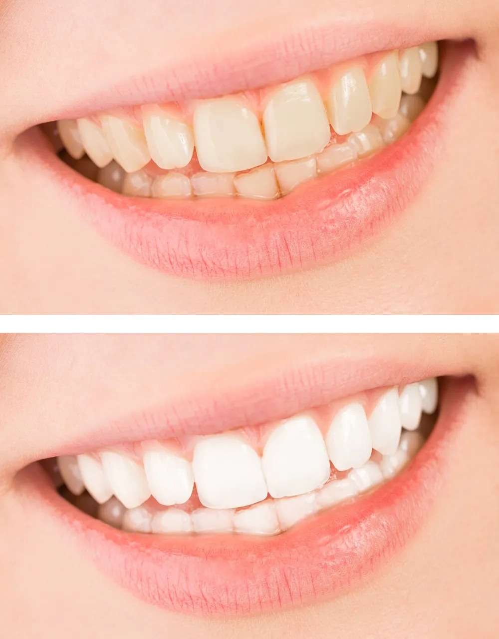 30117 st louis teeth whitening before after