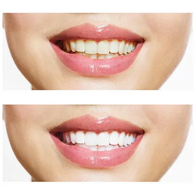 30120 at home teeth whitening