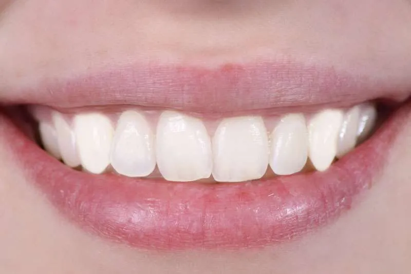 30120 teeth whitening procedure