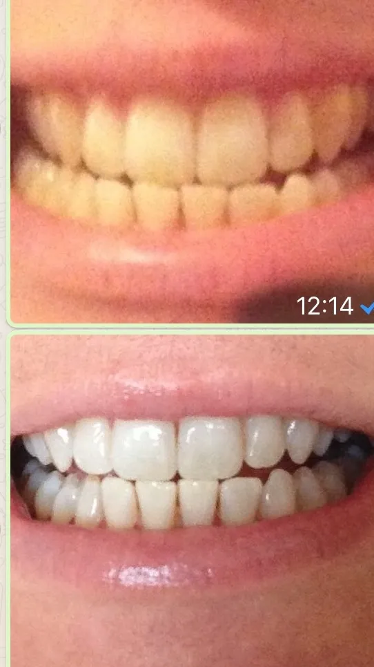 30128 teeth whitening procedure