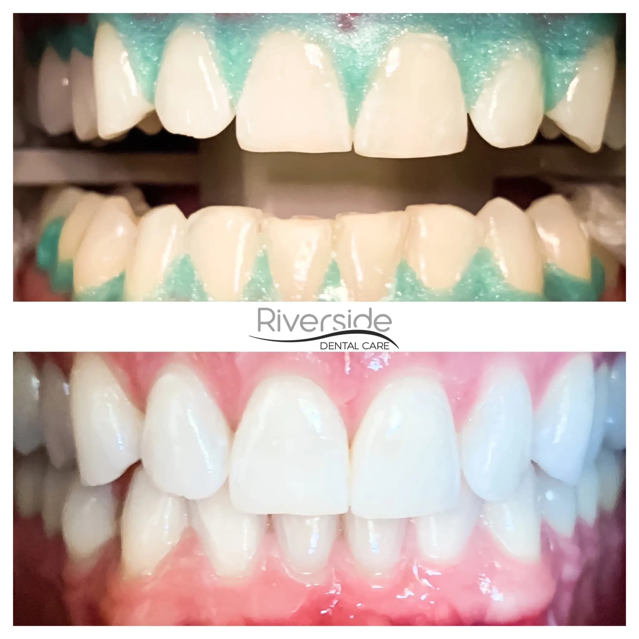 30128 teeth whitening riverside