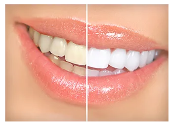 /img/30129-teeth-whitening-daytona-beach-provider-search.webp