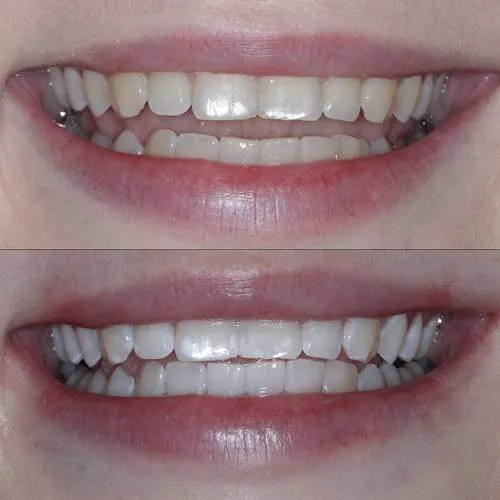 30131 teeth whitening appearance
