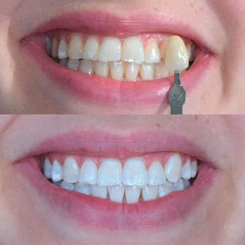 30131 teeth whitening confidence