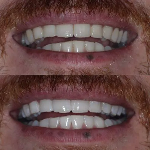 30131 teeth whitening maintenance
