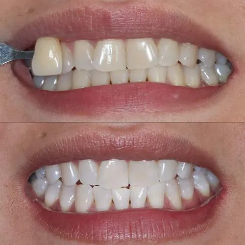 30131 teeth whitening oral health
