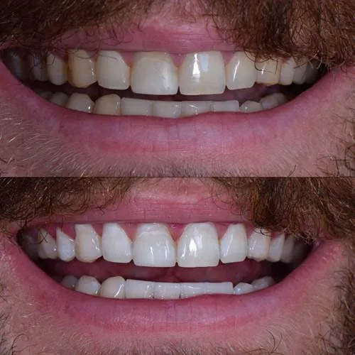 30131 teeth whitening professional