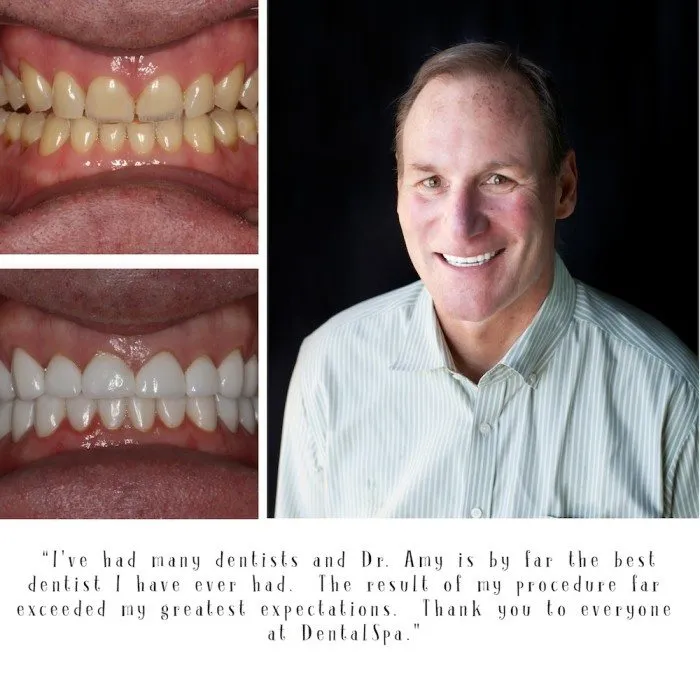 30136 teeth whitening indianapolis before after