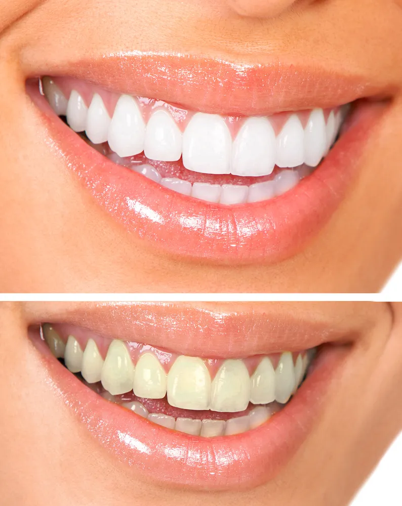 /img/30136-teeth-whitening-indianapolis-cost-factors.webp